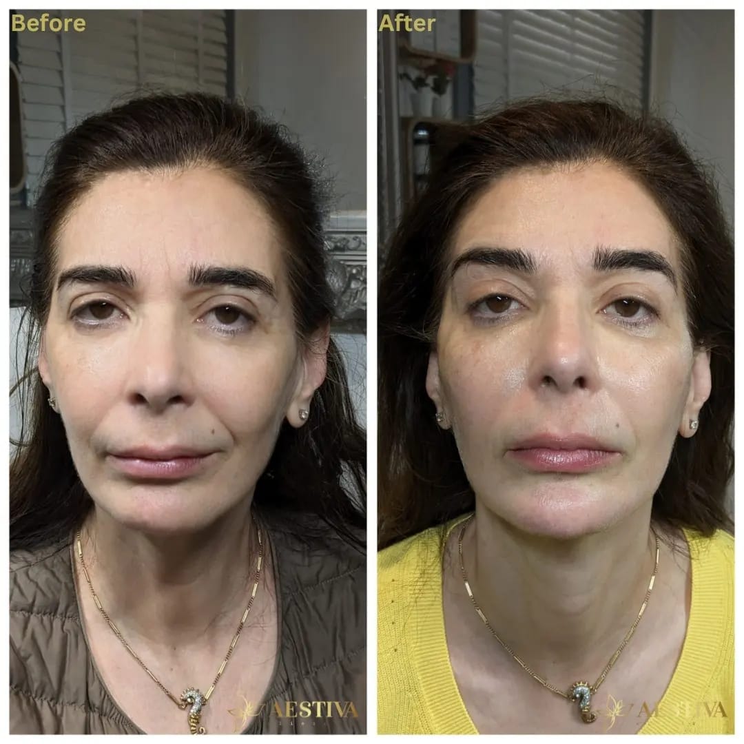 Cheek Filler Before And After Sidcup Kent