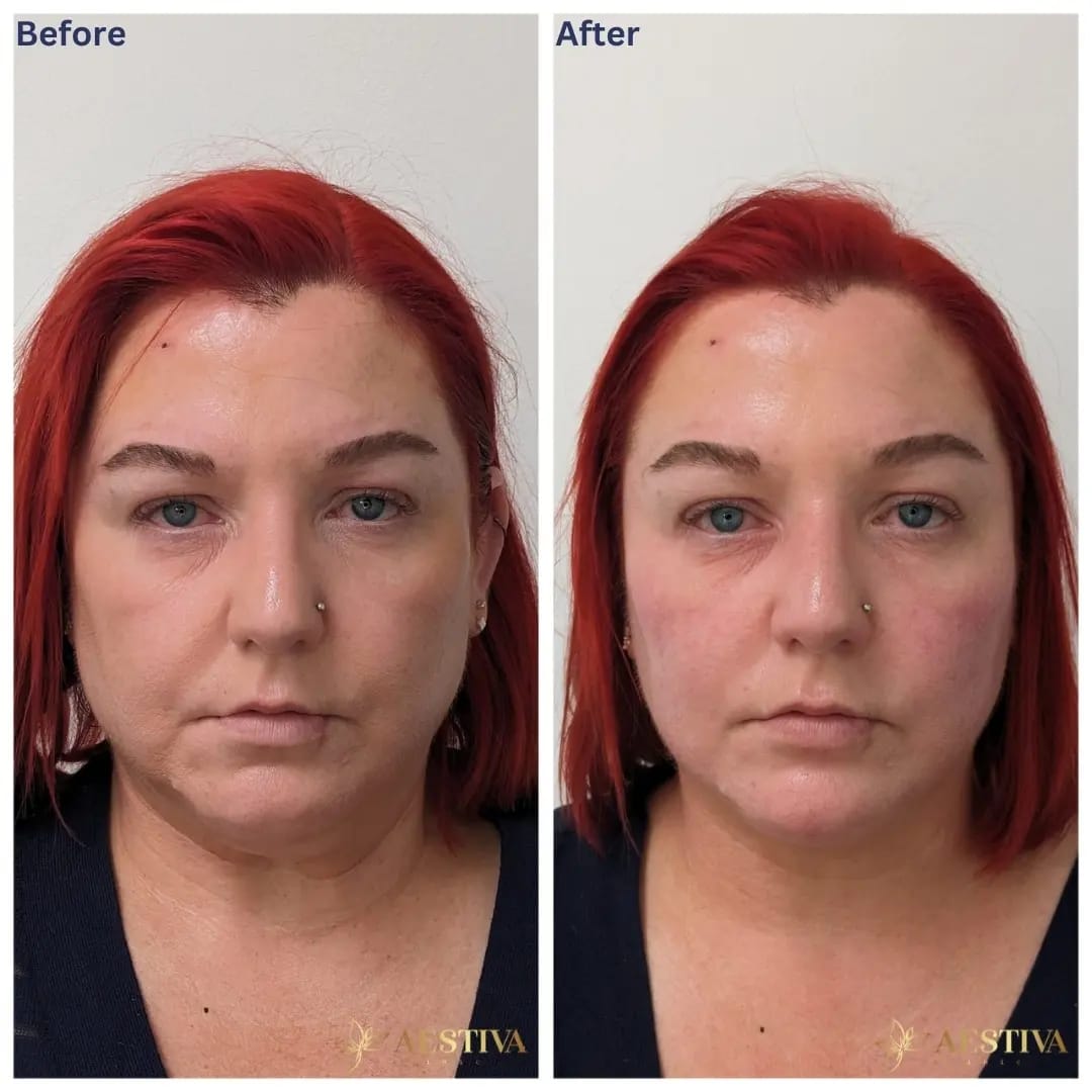 Cheek Filler Before And After Sidcup Kent