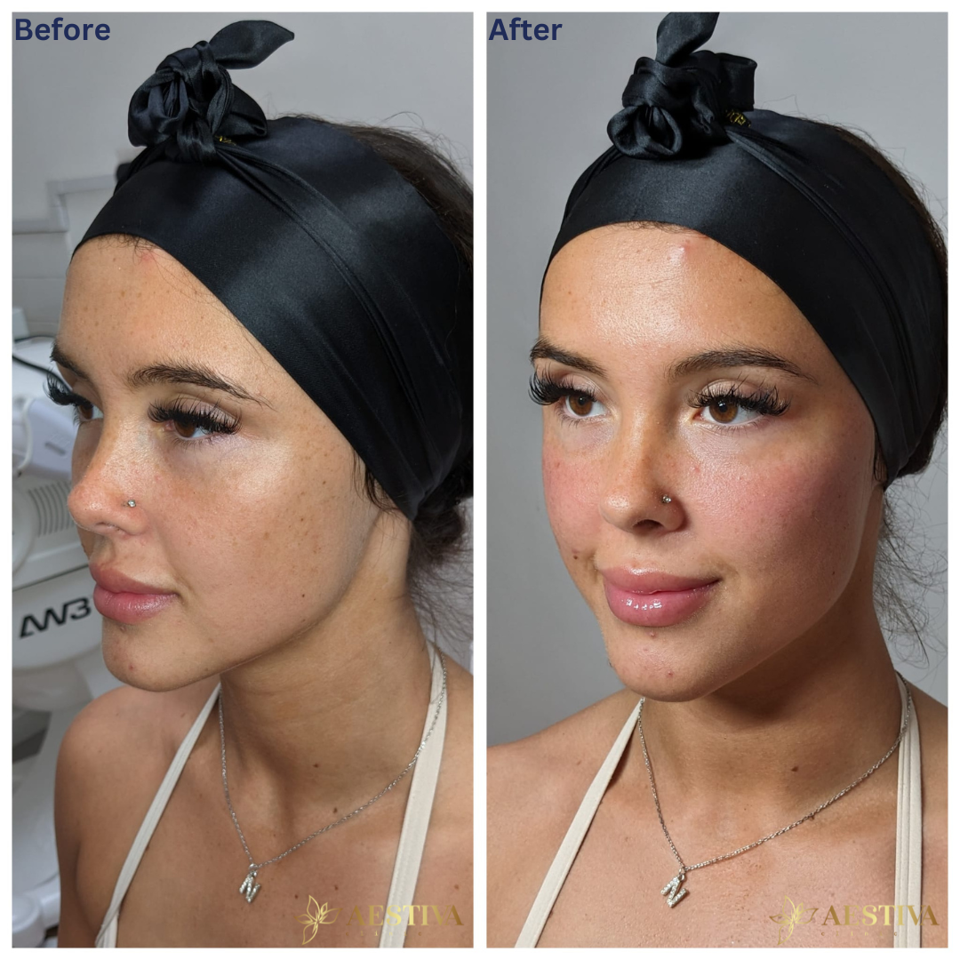 Cheek Filler Before And After Sidcup Kent