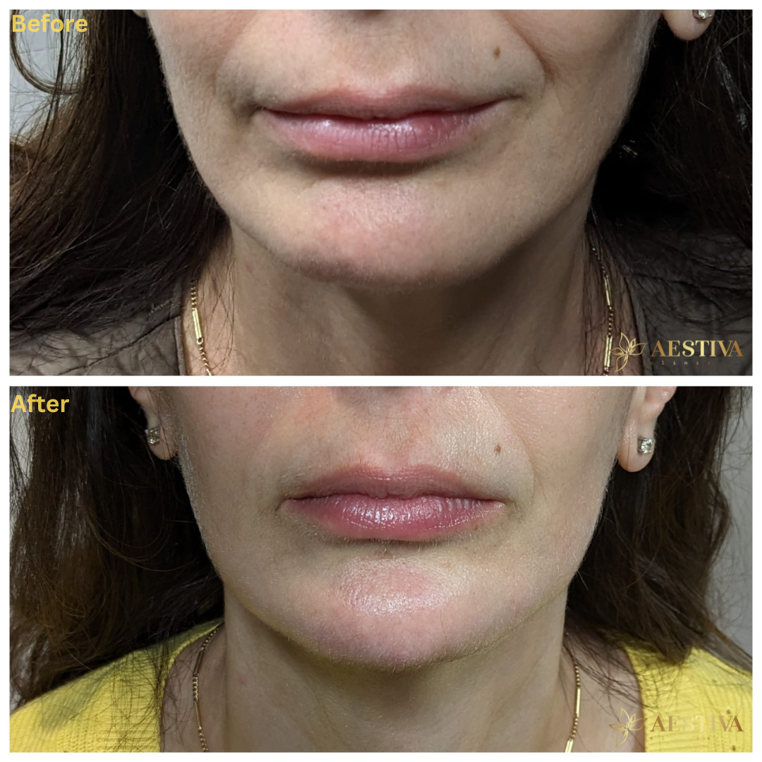 Chin Filler Before and After Sidcup Kent