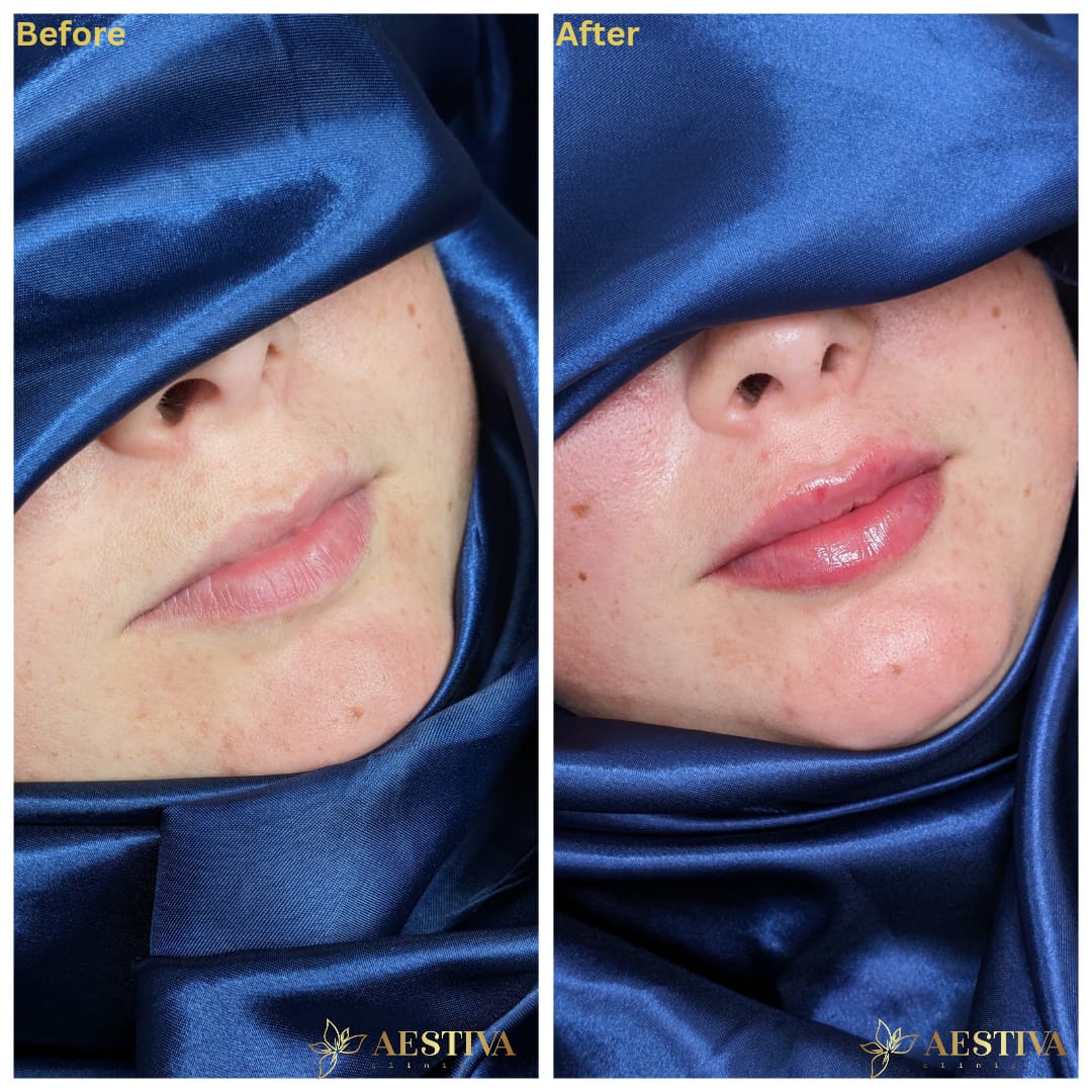 Lip Filler Before And After Sidcup Kent