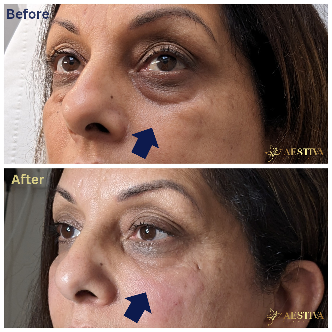 Tear trough filler before and after. Under eye filler before and after