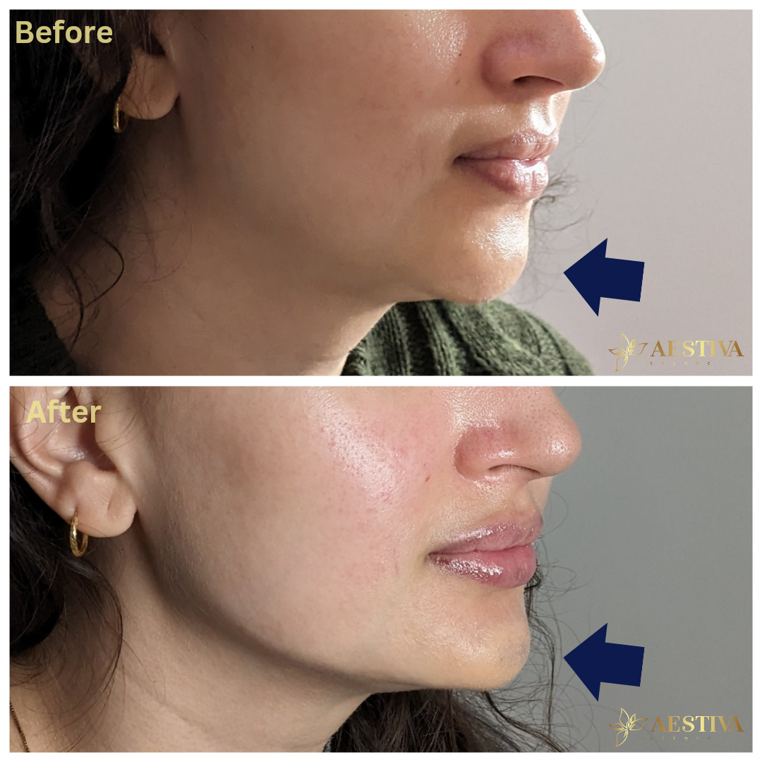 Chin and jawline filler