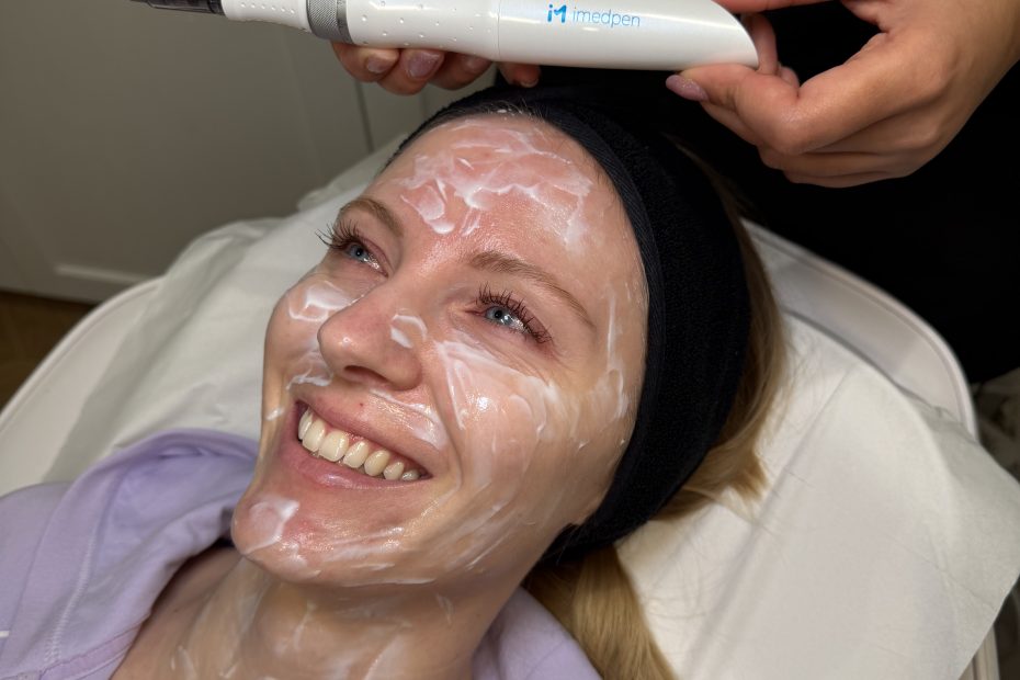 Microneedling in sidcup