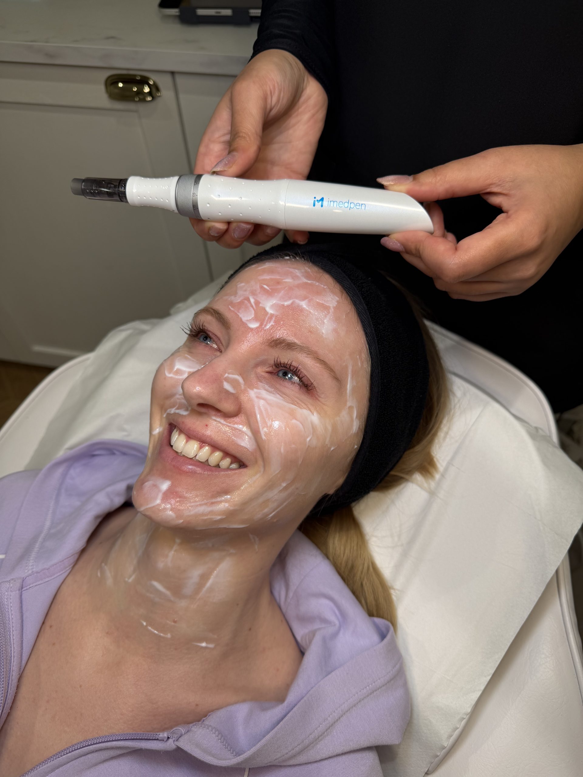 Microneedling in sidcup