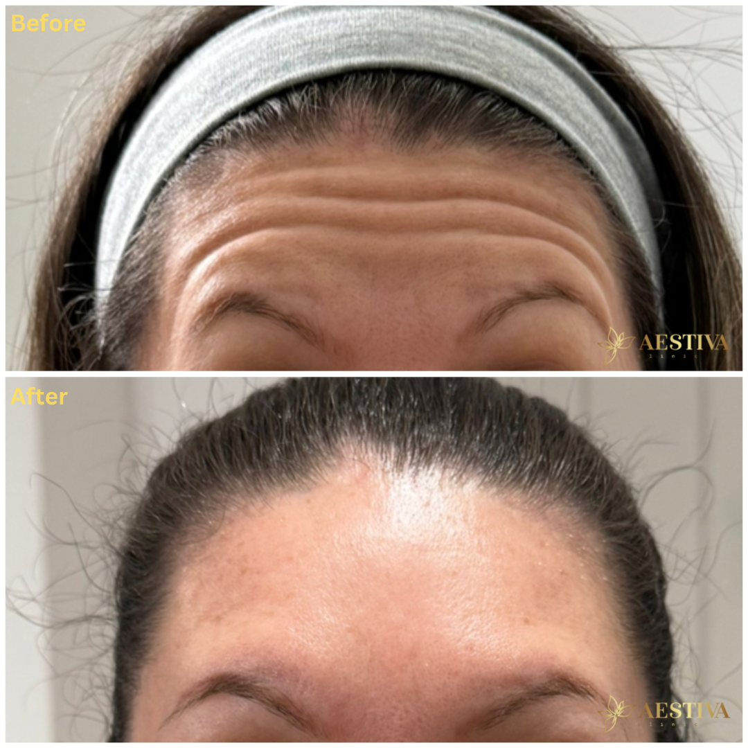 Botox before and after