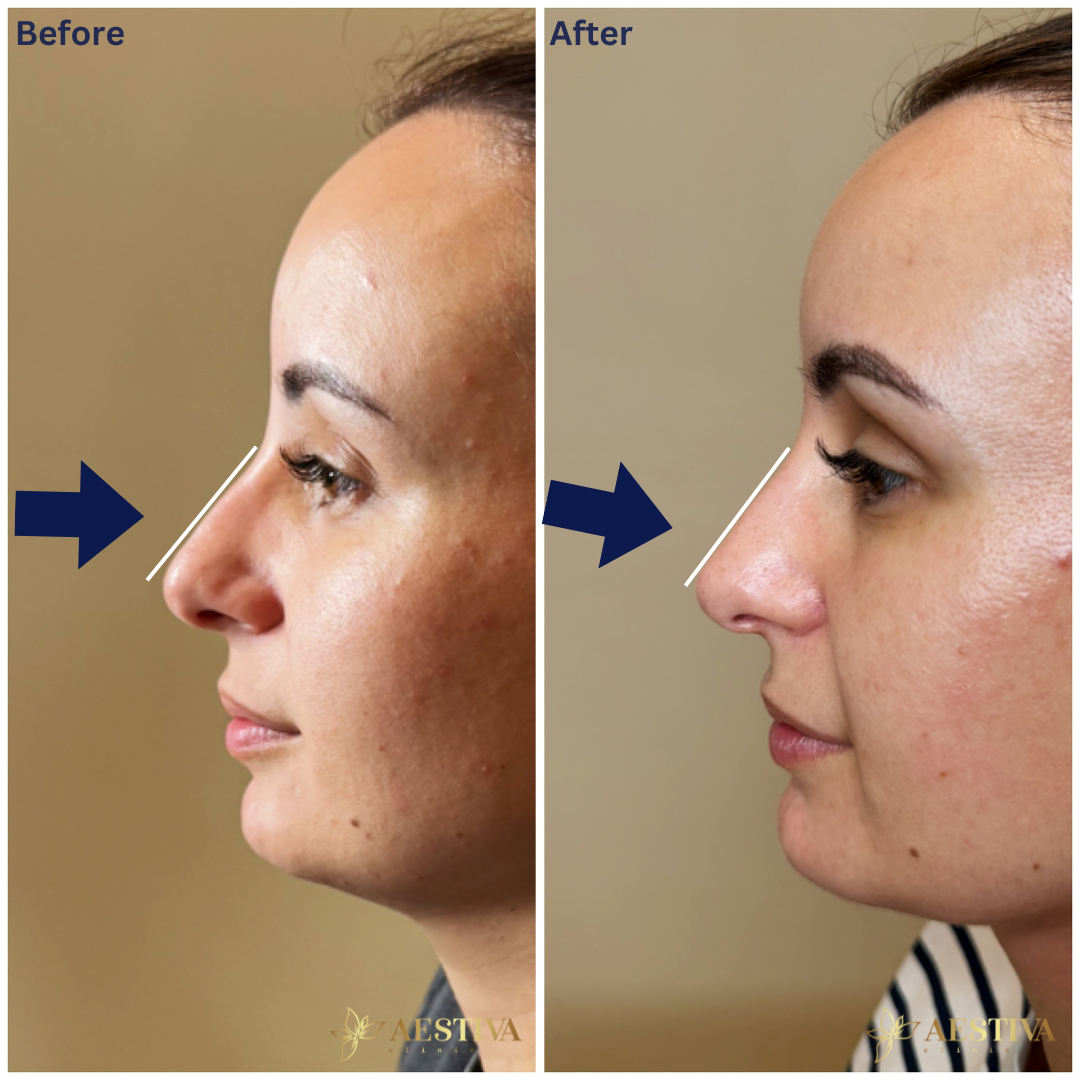 Non-surgical rhinoplasty. Nose filler before and after