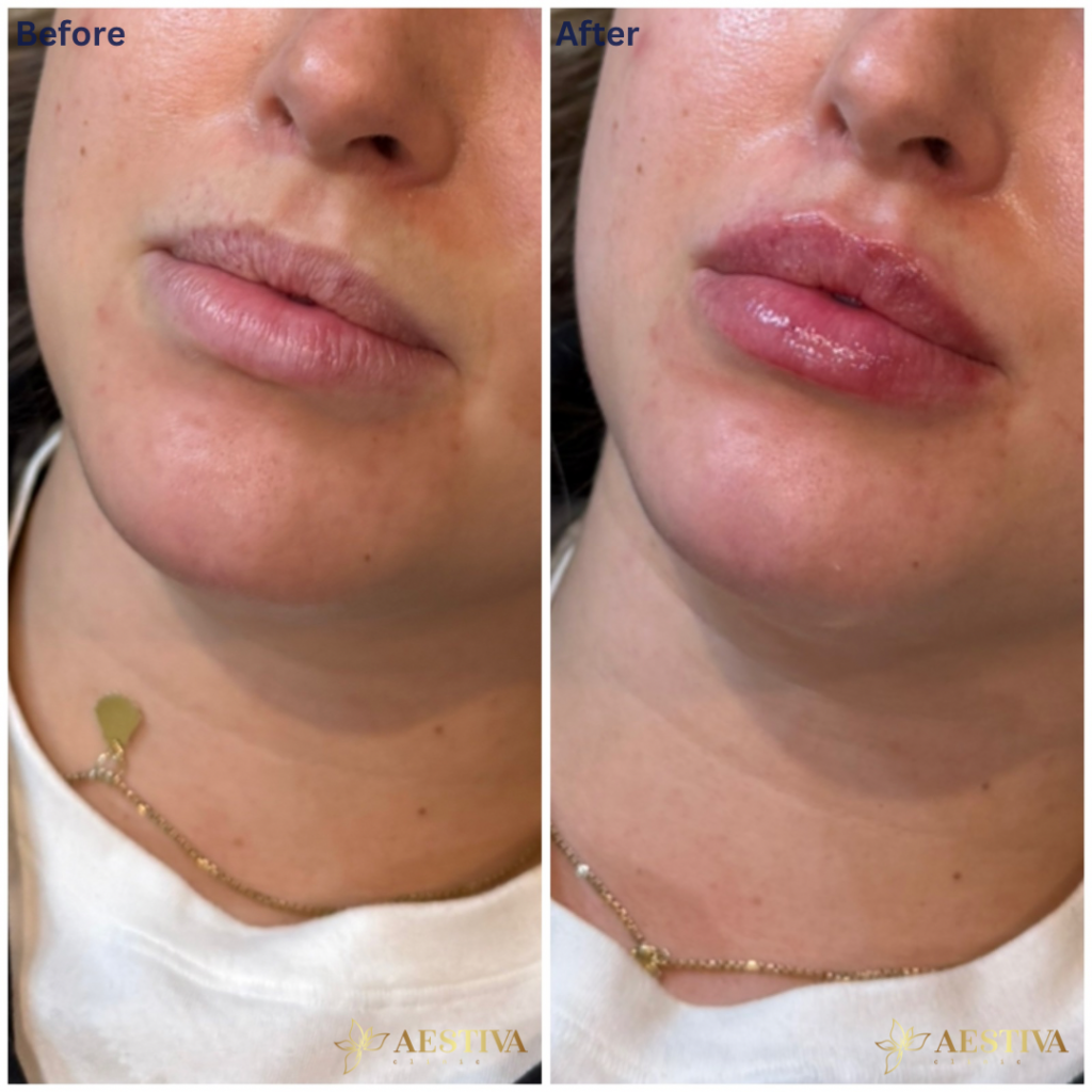 Lip filler before and after. Natural lip filler in sidcup