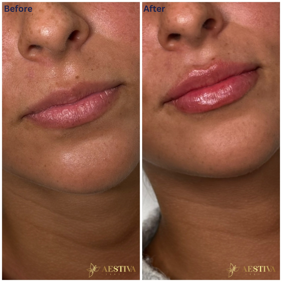 Lip filler before and after. Natural lip filler