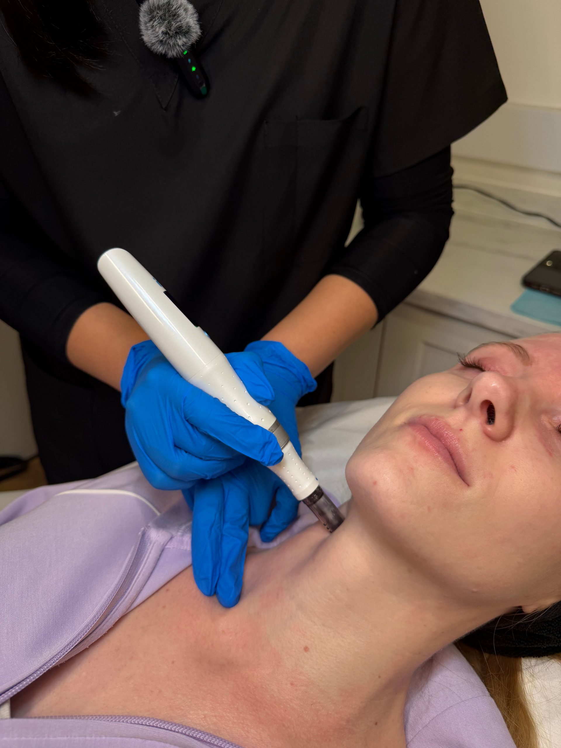 Microneedling sidcup