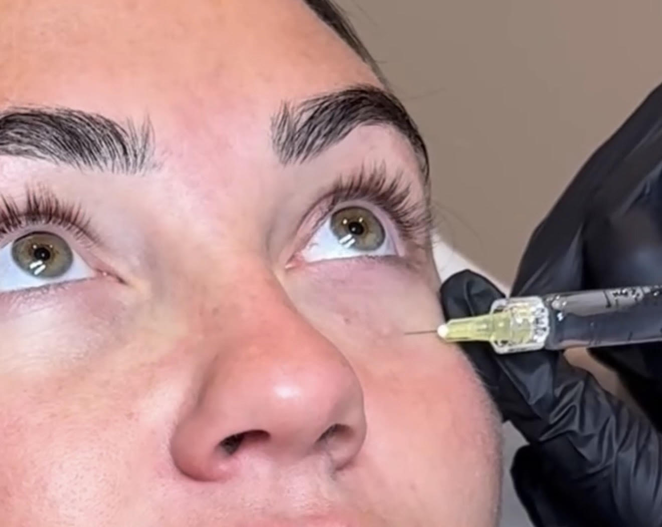 Polynucleotides for under eyes before and after